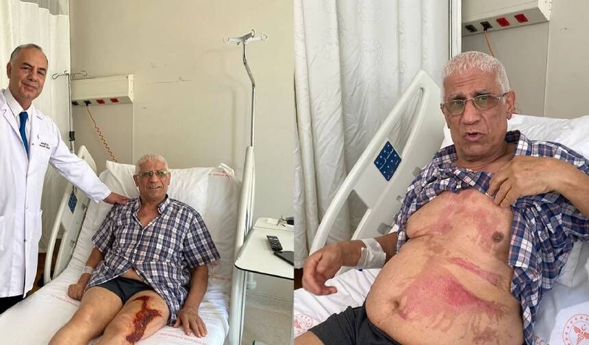 LAVABO AÇICI BOMBA GİBİ PATLADI: VÜCUDUNUN YÜZDE 40'I YANDI